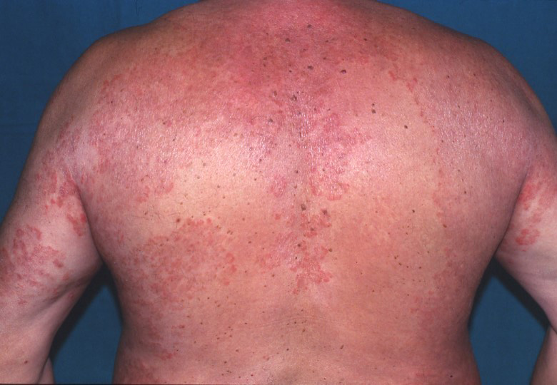 Tinea corporis infection  Ring worm symptoms, treatment and causes 